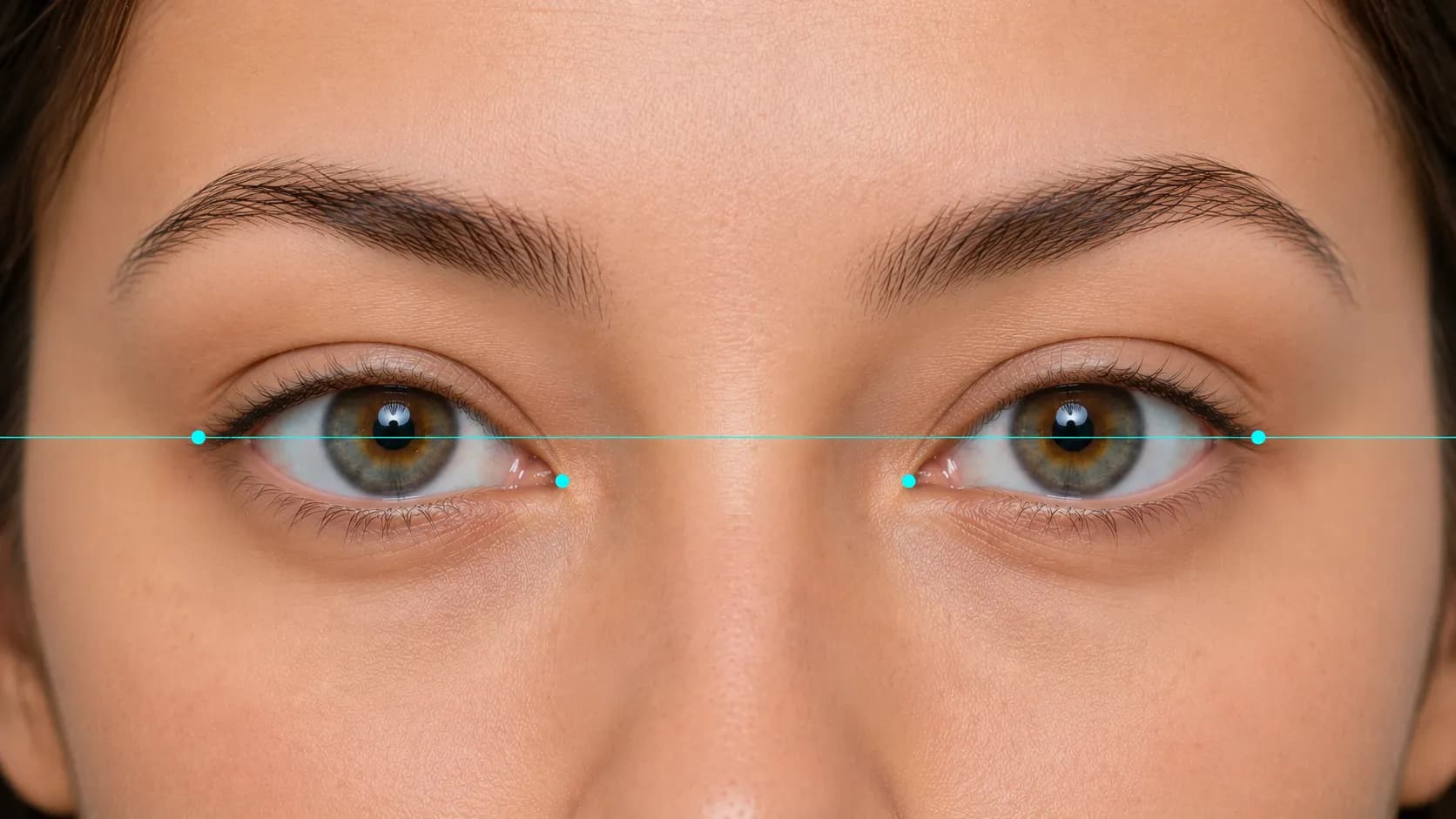 Diagram showing a horizontal line through the pupils used to judge eye corner tilt