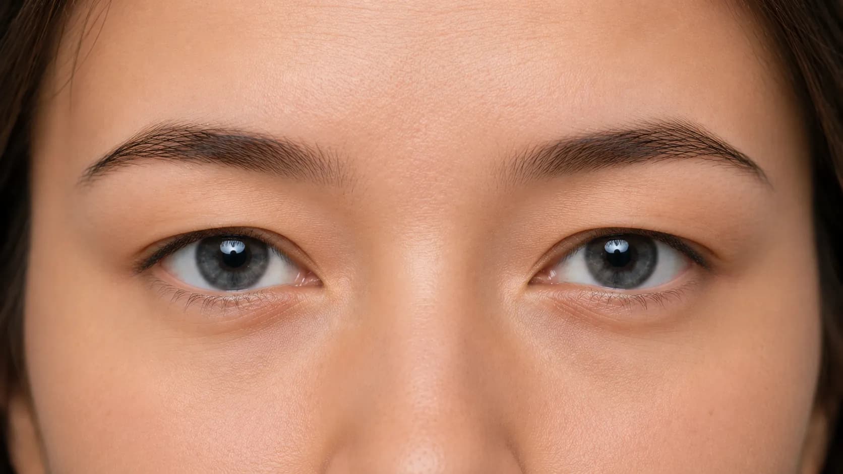 Hooded eyes example where the upper lid fold conceals the crease
