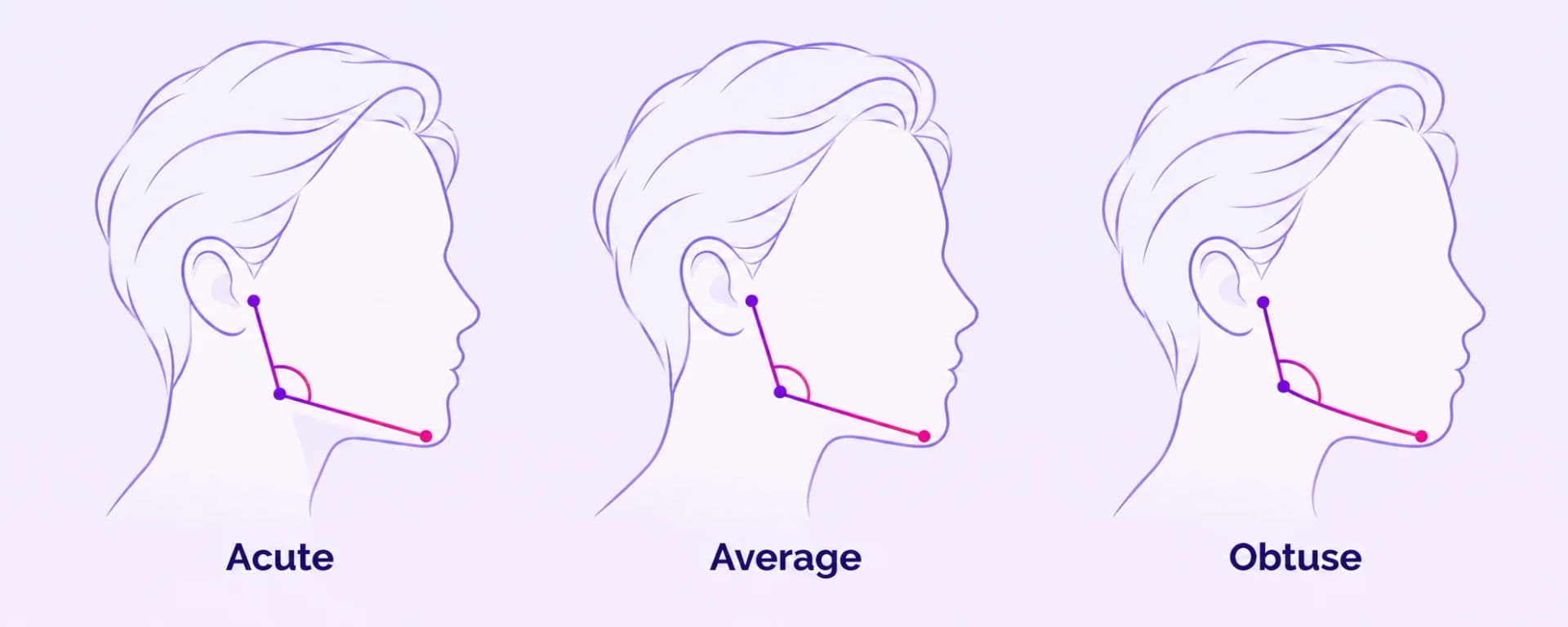 Three side-profile illustrations comparing an acute, average, and obtuse gonial angle